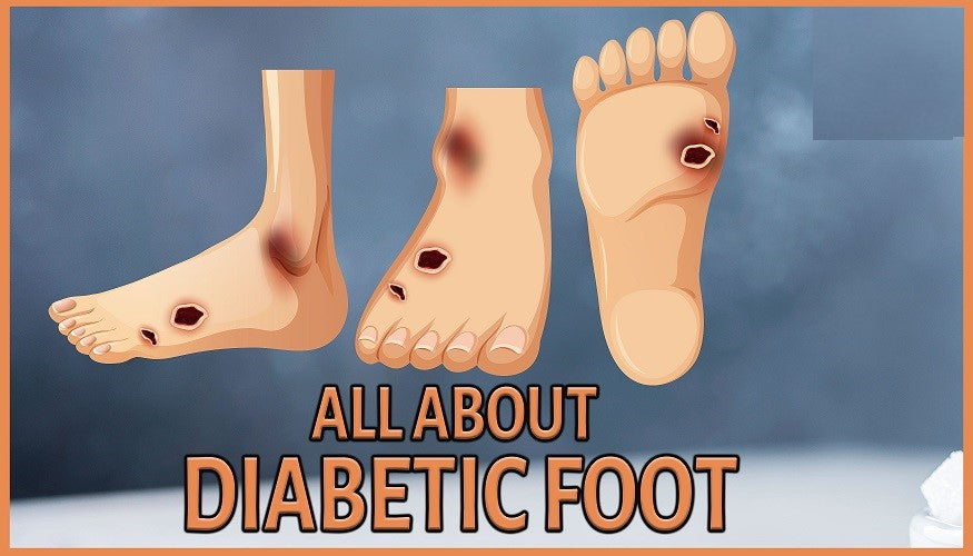 Essential Diabetic Foot Care: Prevention and Management Guide