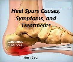 Heel Spurs: Your Guide to Understanding, Treatment, and Prevention