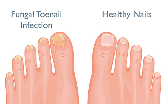 Key to Eliminating Fungal Nail Infections